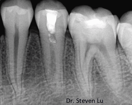 tooth xray