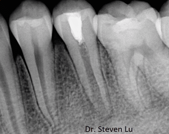 tooth xray