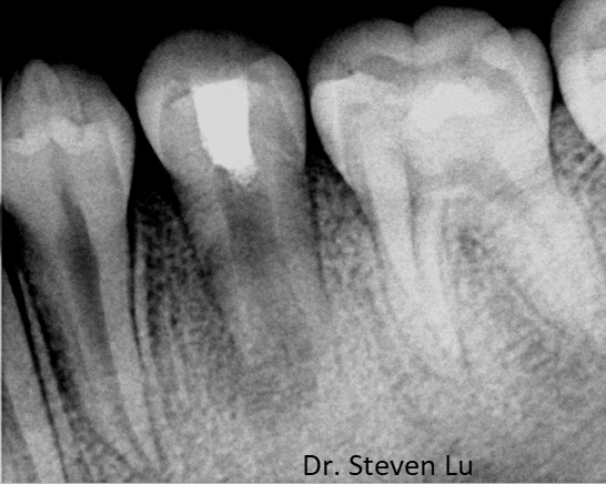 tooth xray