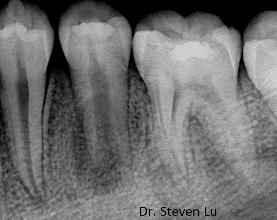 tooth xray